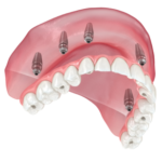 Enhance Your Smile with Cosmetic Dentures: A Modern Solution for a Confident You