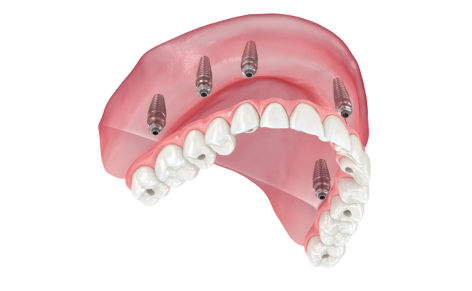 Enhance Your Smile with Cosmetic Dentures: A Modern Solution for a Confident You