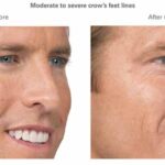 What You Need to Know About Botox Prices in Your Local Area