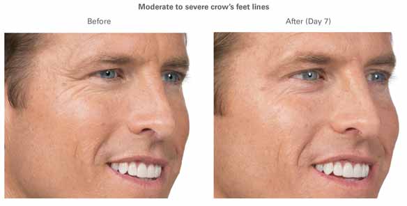 What You Need to Know About Botox Prices in Your Local Area